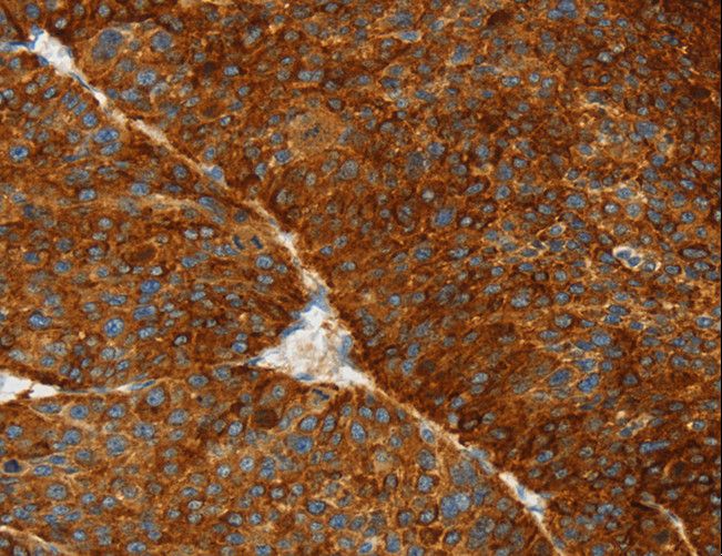 ASGR1 / ASGPR Antibody - Immunohistochemistry of paraffin-embedded Human liver cancer using ASGR1 Polyclonal Antibody at dilution of 1:50.