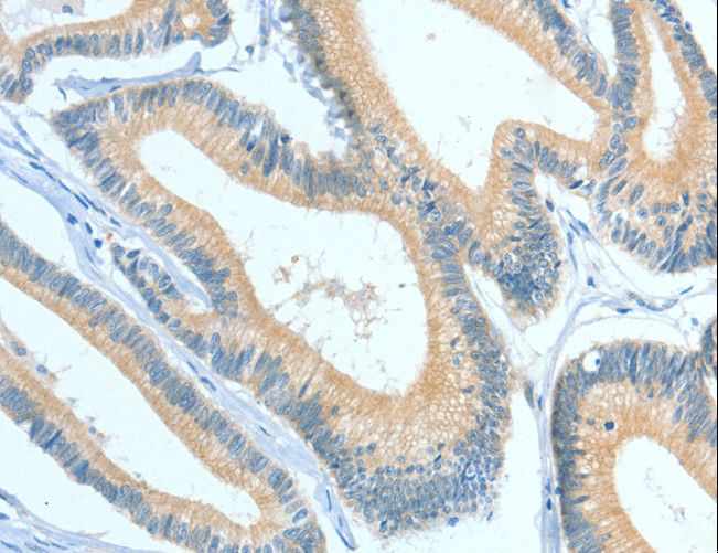 ASGR1 / ASGPR Antibody - Immunohistochemistry of paraffin-embedded Human colon cancer using ASGR1 Polyclonal Antibody at dilution of 1:50.