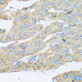 ASGR1 / ASGPR Antibody - Immunohistochemistry of paraffin-embedded Human liver cancer using ASGR1 Polyclonal Antibody at dilution of 1:100 (40x lens).
