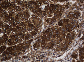 ASGR2 Antibody - IHC of paraffin-embedded Carcinoma of Human liver tissue using anti-ASGR2 mouse monoclonal antibody.