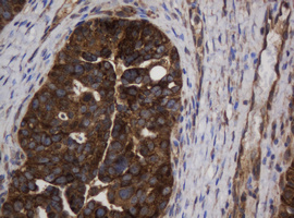 ASGR2 Antibody - IHC of paraffin-embedded Adenocarcinoma of Human ovary tissue using anti-ASGR2 mouse monoclonal antibody.