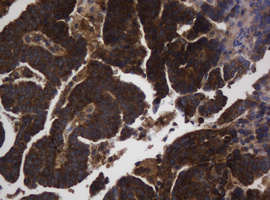 ASGR2 Antibody - IHC of paraffin-embedded Adenocarcinoma of Human endometrium tissue using anti-ASGR2 mouse monoclonal antibody.