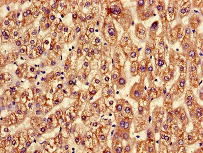 ASGR2 Antibody - Immunohistochemistry of paraffin-embedded human liver cancer using ASGR2 Antibody at dilution of 1:100