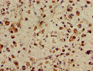 ASH1L / ASH1 Antibody - Immunohistochemistry of paraffin-embedded human glioma cancer using ASH1L Antibody at dilution of 1:100