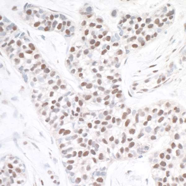 ASH2L / ASH2 Antibody - Detection of human ASH2 by immunohistochemistry. Sample: FFPE section of human breast carcinoma. Antibody: Affinity purified rabbit anti-ASH2 used at a dilution of 1:1,000 (1µg/ml). Detection: DAB