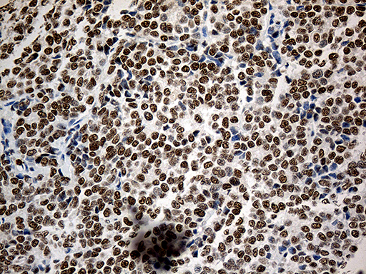 ASH2L / ASH2 Antibody - Immunohistochemical staining of paraffin-embedded Adenocarcinoma of Human breast tissue tissue using anti-ASH2L mouse monoclonal antibody. (Heat-induced epitope retrieval by 1mM EDTA in 10mM Tris buffer. (pH8.5) at 120°C for 3 min. (1:500)