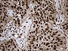 ASH2L / ASH2 Antibody - Immunohistochemical staining of paraffin-embedded Carcinoma of Human lung tissue using anti-ASH2L mouse monoclonal antibody. (Heat-induced epitope retrieval by 1mM EDTA in 10mM Tris buffer. (pH8.5) at 120°C for 3 min. (1:2000)