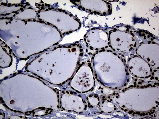 ASH2L / ASH2 Antibody - Immunohistochemical staining of paraffin-embedded Human thyroid tissue within the normal limits using anti-ASH2L mouse monoclonal antibody. (Heat-induced epitope retrieval by 1mM EDTA in 10mM Tris buffer. (pH8.5) at 120°C for 3 min. (1:2000)