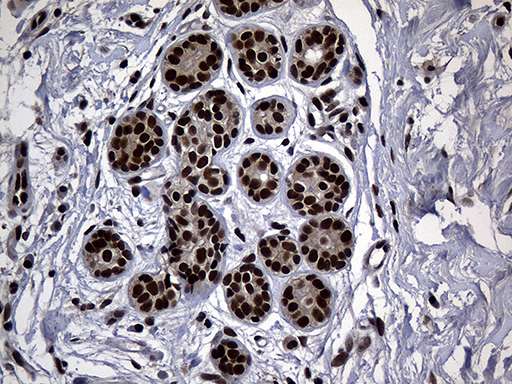 ASH2L / ASH2 Antibody - Immunohistochemical staining of paraffin-embedded Adenocarcinoma of Human breast tissue tissue using anti-ASH2L mouse monoclonal antibody. (Heat-induced epitope retrieval by 1mM EDTA in 10mM Tris buffer. (pH8.5) at 120°C for 3 min. (1:2000)