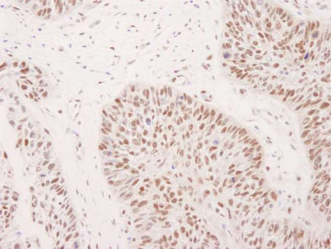 ASH2L / ASH2 Antibody - Detection of Human ASH2 by Immunohistochemistry. Sample: FFPE section of human laryngeal squamous cell carcinoma. Antibody: Affinity purified rabbit anti-ASH2 used at a dilution of 1:1000 (1 ug/ml).