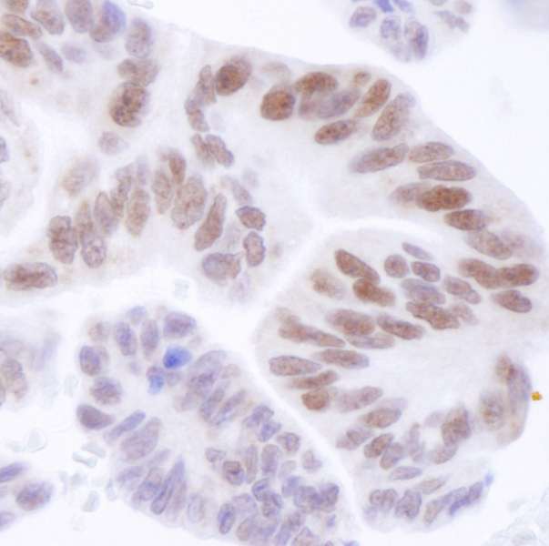 ASH2L / ASH2 Antibody - Detection of Human ASH2 by Immunohistochemistry. Sample: FFPE section of human ovarian carcinoma. Antibody: Affinity purified rabbit anti-ASH2 used at a dilution of 1:250. Detection: DAB staining using anti-Rabbit IHC antibody at a dilution of 1:100.