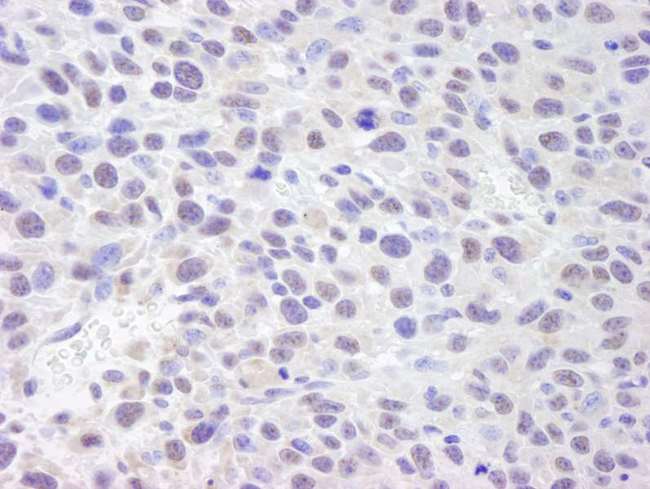 ASH2L / ASH2 Antibody - Detection of Mouse ASH2 by Immunohistochemistry. Sample: FFPE section of mouse squamous cell carcinoma. Antibody: Affinity purified rabbit anti-ASH2 used at a dilution of 1:250. Detection: DAB staining using anti-Rabbit IHC antibody at a dilution of 1:100.