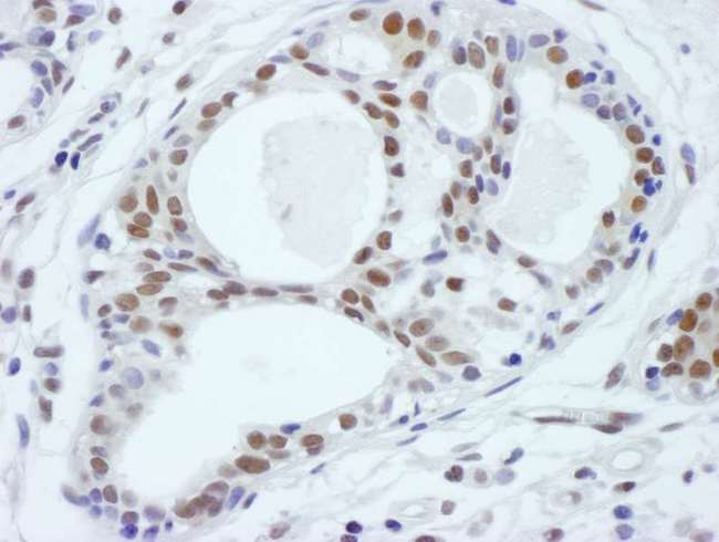 ASH2L / ASH2 Antibody - Detection of human ASH2 by immunohistochemistry. Sample: FFPE section of human breast carcinoma. Antibody: Affinity purified rabbit anti-ASH2 used at a dilution of 1:250. Detection: DAB staining using anti-rabbit IHC antibody at a dilution of 1:100.