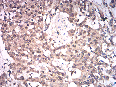 ASH2L / ASH2 Antibody - Immunohistochemical analysis of paraffin-embedded esophageal cancer tissues using ASH2L mouse mAb with DAB staining.