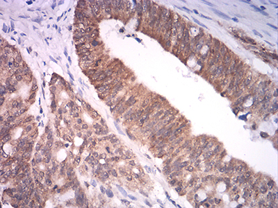 ASH2L / ASH2 Antibody - Immunohistochemical analysis of paraffin-embedded rectum cancer tissues using ASH2L mouse mAb with DAB staining.