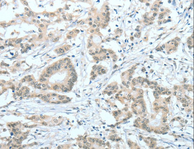 ASH2L / ASH2 Antibody - Immunohistochemistry of paraffin-embedded Human thyroid cancer using ASH2L Polyclonal Antibody at dilution of 1:60.