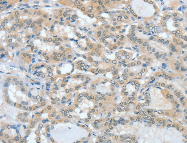 ASH2L / ASH2 Antibody - Immunohistochemistry of paraffin-embedded Human thyroid cancer using ASH2L Polyclonal Antibody at dilution of 1:60.