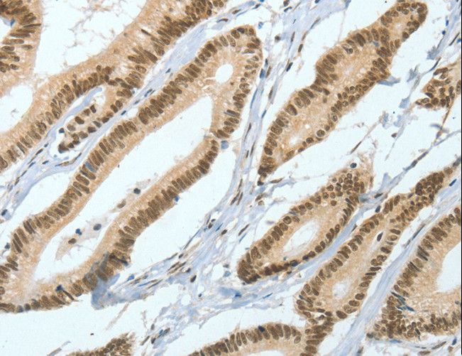 ASH2L / ASH2 Antibody - Immunohistochemistry of paraffin-embedded Human liver cancer using ASH2L Polyclonal Antibody at dilution of 1:50.
