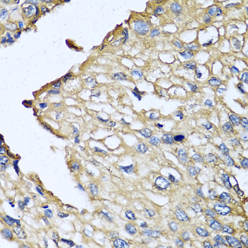 ASIP Antibody - Immunohistochemistry of paraffin-embedded human prostate cancer tissue.