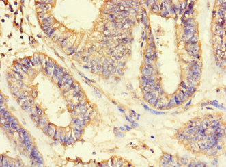 ASIP Antibody - Paraffin-embedding Immunohistochemistry using human endometrial cancer at dilution 1:100