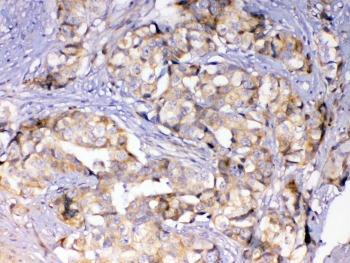 ASL / Argininosuccinate Lyase Antibody - IHC testing of FFPE human breast cancer tissue with ASL antibody at 1ug/ml. Required HIER: steam section in pH6 citrate buffer for 20 min and allow to cool prior to testing.
