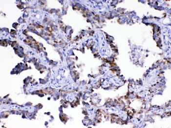 ASL / Argininosuccinate Lyase Antibody - IHC testing of FFPE human lung cancer tissue with ASL antibody at 1ug/ml. Required HIER: steam section in pH6 citrate buffer for 20 min and allow to cool prior to testing.