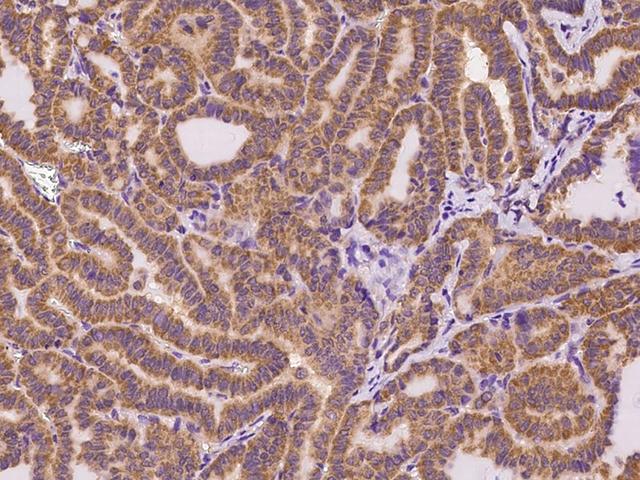 ASL / Argininosuccinate Lyase Antibody - Immunochemical staining of human ASL in human thyroid cancer with rabbit polyclonal antibody at 1:200 dilution, formalin-fixed paraffin embedded sections.