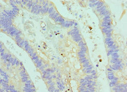ASMTL Antibody - Immunohistochemistry of paraffin-embedded human colon cancer using ASMTL Antibody at dilution of 1:100