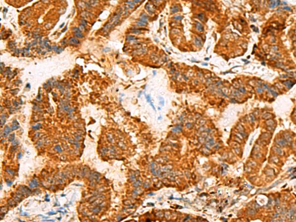 ASMTL Antibody - Immunohistochemistry of paraffin-embedded Human thyroid cancer tissue  using ASMTL Polyclonal Antibody at dilution of 1:100(×200)