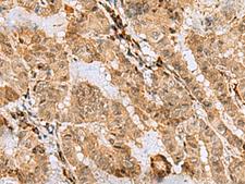 ASNA1 Antibody - Immunohistochemistry of paraffin-embedded Human thyroid cancer tissue  using ASNA1 Polyclonal Antibody at dilution of 1:70(×200)