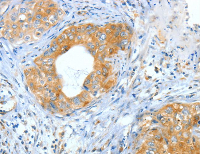 ASNS Antibody - Immunohistochemistry of paraffin-embedded Human cervical cancer using ASNS Polyclonal Antibody at dilution of 1:60.