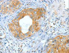 ASNS Antibody - Immunohistochemistry of paraffin-embedded Human cervical cancer using ASNS Polyclonal Antibody at dilution of 1:60.
