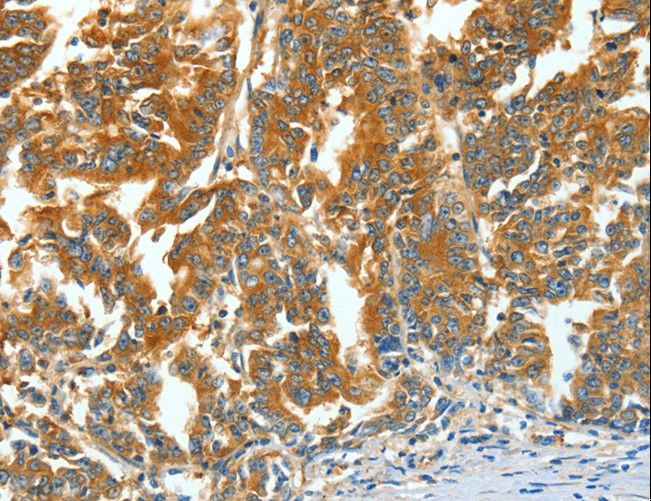 ASNS Antibody - Immunohistochemistry of paraffin-embedded Human gastric cancer using ASNS Polyclonal Antibody at dilution of 1:60.