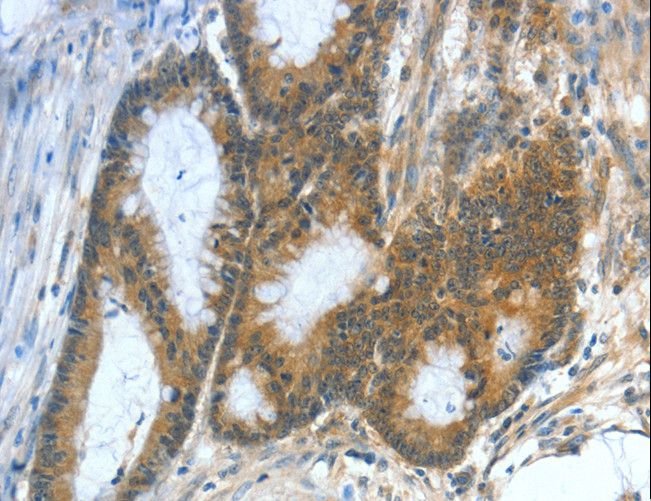 ASNS Antibody - Immunohistochemistry of paraffin-embedded Human colon cancer using ASNS Polyclonal Antibody at dilution of 1:50.