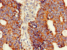ASNS Antibody - Immunohistochemistry of paraffin-embedded human colon cancer at dilution of 1:100