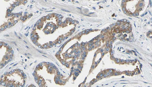 ASNS Antibody - 1:100 staining human prostate tissue by IHC-P. The sample was formaldehyde fixed and a heat mediated antigen retrieval step in citrate buffer was performed. The sample was then blocked and incubated with the antibody for 1.5 hours at 22°C. An HRP conjugated goat anti-rabbit antibody was used as the secondary.