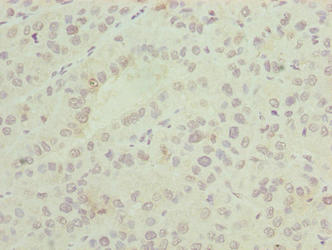 ASNSD1 Antibody - Immunohistochemistry of paraffin-embedded human liver cancer using ASNSD1 Antibody at dilution of 1:100