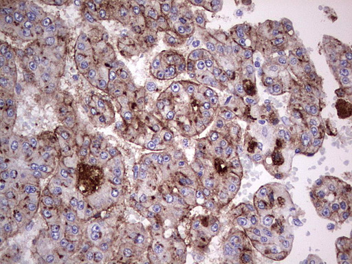 ASPA Antibody - Immunohistochemical staining of paraffin-embedded Carcinoma of Human liver tissue using anti-ASPA mouse monoclonal antibody. (Heat-induced epitope retrieval by 1 mM EDTA in 10mM Tris, pH8.5, 120C for 3min,