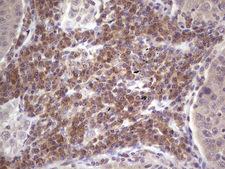 ASPA Antibody - Immunohistochemical staining of paraffin-embedded Carcinoma of Human lung tissue using anti-ASPA mouse monoclonal antibody. (Heat-induced epitope retrieval by 1 mM EDTA in 10mM Tris, pH8.5, 120C for 3min,
