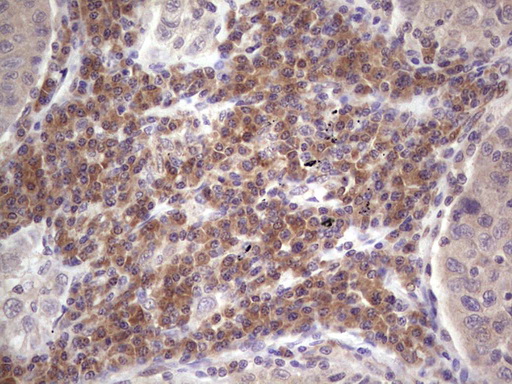 ASPA Antibody - IHC of paraffin-embedded Carcinoma of Human lung tissue using anti-ASPA mouse monoclonal antibody. (Heat-induced epitope retrieval by 1 mM EDTA in 10mM Tris, pH8.5, 120°C for 3min).