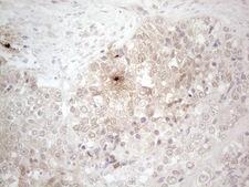 ASPA Antibody - Immunohistochemical staining of paraffin-embedded Adenocarcinoma of Human endometrium tissue using anti-ASPA mouse monoclonal antibody. (Heat-induced epitope retrieval by 1mM EDTA in 10mM Tris buffer. (pH8.5) at 120°C for 3 min. (1:150)