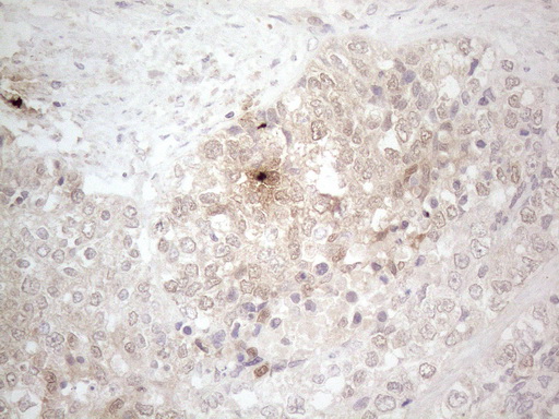 ASPA Antibody - Immunohistochemical staining of paraffin-embedded Adenocarcinoma of Human endometrium tissue using anti-ASPA mouse monoclonal antibody. (Heat-induced epitope retrieval by 1mM EDTA in 10mM Tris buffer. (pH8.5) at 120°C for 3 min. (1:150)