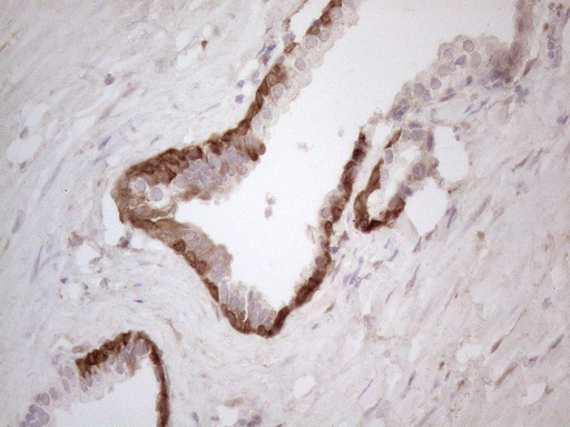 ASPA Antibody - Immunohistochemical staining of paraffin-embedded Carcinoma of Human prostate tissue using anti-ASPA mouse monoclonal antibody. (Heat-induced epitope retrieval by 1mM EDTA in 10mM Tris buffer. (pH8.5) at 120°C for 3 min. (1:150)