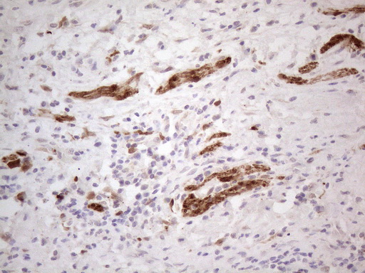 ASPA Antibody - Immunohistochemical staining of paraffin-embedded Carcinoma of Human bladder tissue using anti-ASPA mouse monoclonal antibody. (Heat-induced epitope retrieval by 1mM EDTA in 10mM Tris buffer. (pH8.5) at 120°C for 3 min. (1:150)