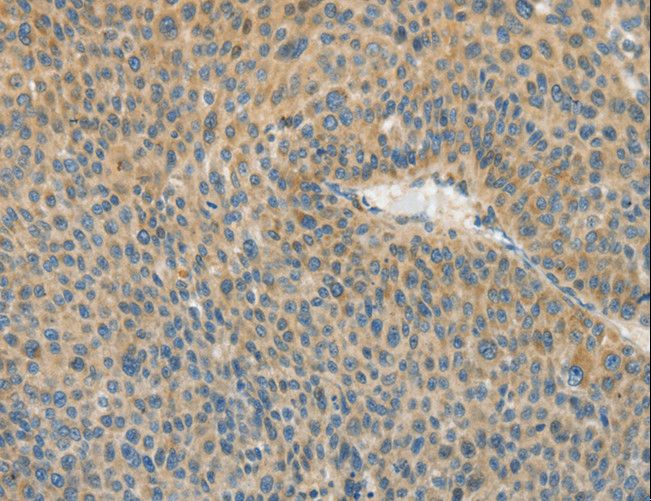 ASPA Antibody - Immunohistochemistry of paraffin-embedded Human liver cancer using ASPA Polyclonal Antibody at dilution of 1:80.