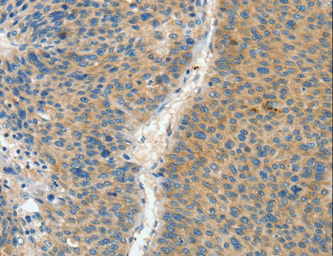 ASPA Antibody - Immunohistochemistry of paraffin-embedded Human liver cancer using ASPA Polyclonal Antibody at dilution of 1:60.