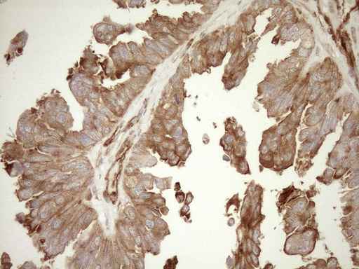 ASPDH Antibody - Immunohistochemical staining of paraffin-embedded Adenocarcinoma of Human ovary tissue using anti-ASPDH mouse monoclonal antibody. (Heat-induced epitope retrieval by 1mM EDTA in 10mM Tris buffer. (pH8.5) at 120°C for 3 min. (1:150)