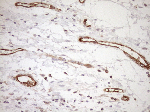 ASPDH Antibody - Immunohistochemical staining of paraffin-embedded Carcinoma of Human pancreas tissue using anti-ASPDH mouse monoclonal antibody. (Heat-induced epitope retrieval by 1mM EDTA in 10mM Tris buffer. (pH8.5) at 120°C for 3 min. (1:150)