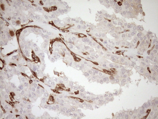 ASPDH Antibody - Immunohistochemical staining of paraffin-embedded Carcinoma of Human thyroid tissue using anti-ASPDH mouse monoclonal antibody. (Heat-induced epitope retrieval by 1mM EDTA in 10mM Tris buffer. (pH8.5) at 120°C for 3 min. (1:150)