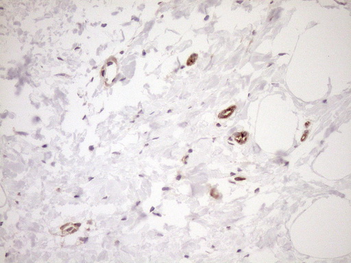 ASPDH Antibody - Immunohistochemical staining of paraffin-embedded Adenocarcinoma of Human breast tissue using anti-ASPDH mouse monoclonal antibody. (Heat-induced epitope retrieval by 1mM EDTA in 10mM Tris buffer. (pH8.5) at 120°C for 3 min. (1:150)
